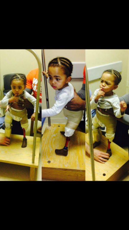 Kayden Knickle learns to use Prostetic legs (82389)